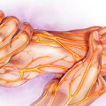 Can you reverse neuropathy?
