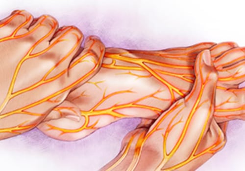 Can you reverse neuropathy?